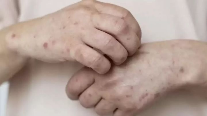 В Казахстане растёт заболеваемость корью: Минздрав усилил меры профилактики